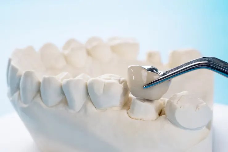 Dental crowns