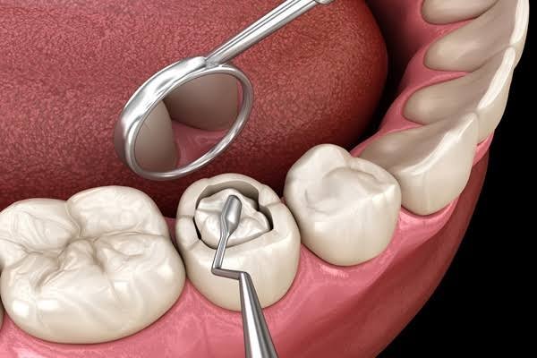 Dental fillings