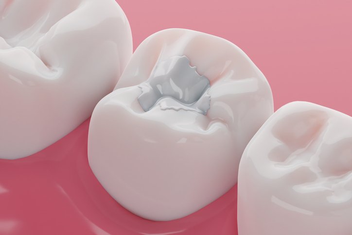 White fillings